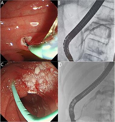 Analysis of the Efficacy and Safety of Endoscopic Retrograde Cholangiopancreatography in Children With Symptomatic Pancreas Divisum